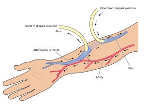 Fistule arterio-veineuse